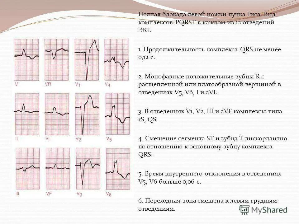 Блокада левого и правого пучка гиса. Двухпучковая блокада ножек пучка Гиса. Полная блокада ЛНПГ на ЭКГ. Двухпучковая блокада ножек пучка Гиса на ЭКГ. Блокада ножек пучка Гиса на ЭКГ.