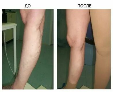 Лазерная флебология сочи