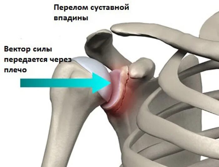 Краевой перелом суставного отростка лопатки. Суставная впадина лопатки перелом. Краевой перелом суставной поверхности лопатки. Суставная губа плечевого сустава. Повреждения правого плечевого сустава