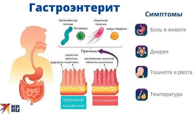 Питание при остром гастроэнтерите. Что можно есть при гастроэнтерите. Гастроэнтерит симптомы. Острый гастроэнтерит средней степени тяжести. Острый гастроэнтерит у детей.