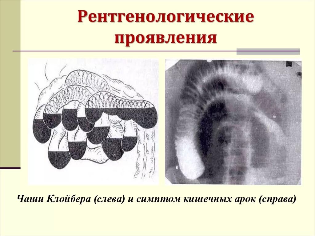 Кишечная непроходимость рентген чаши клойбера. Рентген чаши клойбера. Рентген чаши клойбера. Рентген брюшной полости чаши клойбера. Чаши клойбера на рентгенограмме толстокишечные.