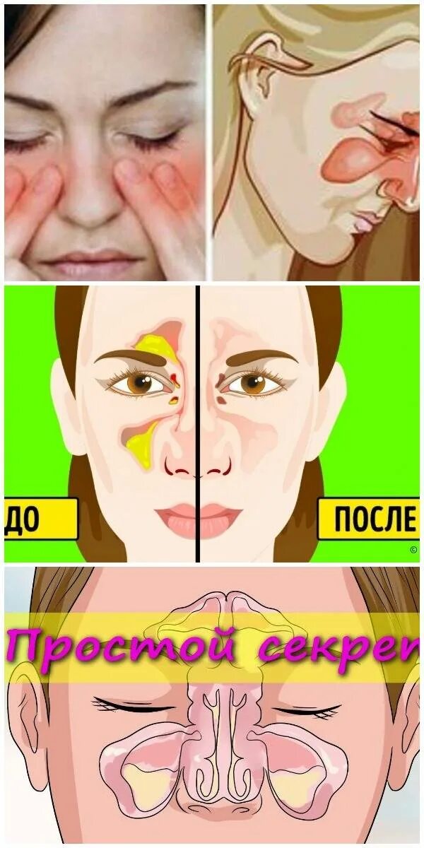 Как избавиться от заложенности без капель. Избавиться от заложенности носа. методы от заложенности носа. методика от заложенности носа.
