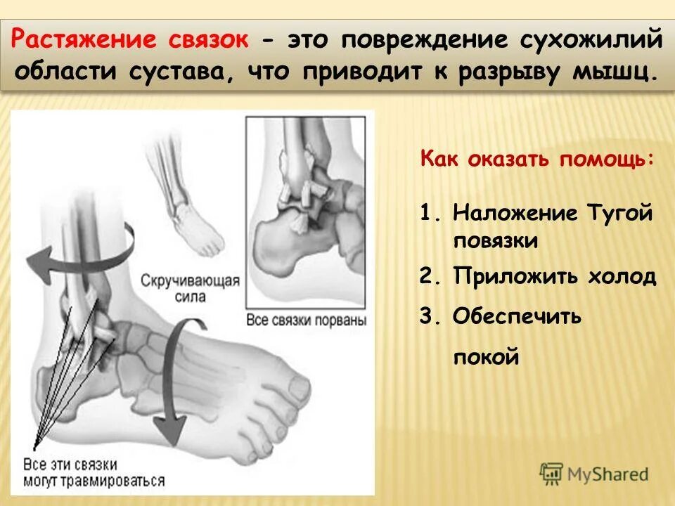 Первая при растяжении связок. Алгоритм оказания первой помощи при растяжении связок голеностопа. Растяжения связок, разрывы мышц. Оказание первой помощи. При растяжении связок при оказании первой помощи. Оказание первой помощи при разрывах связок и мышц.