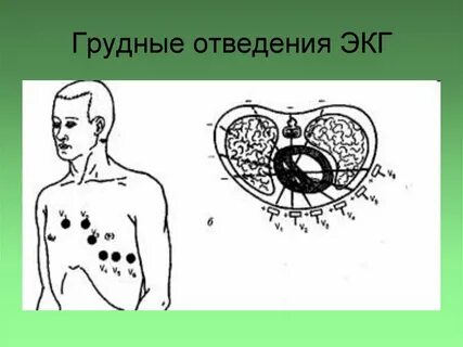 Правые грудные отведения на экг