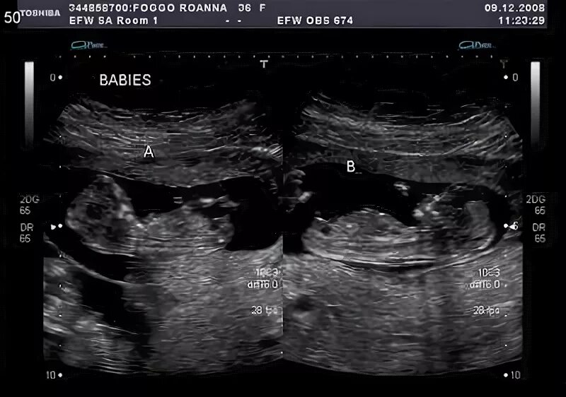 23 недели двойня. УЗИ 13 недель беременности двойня. УЗИ 13 недель беременности Близнецы. УЗИ двойняшек 13 недель.