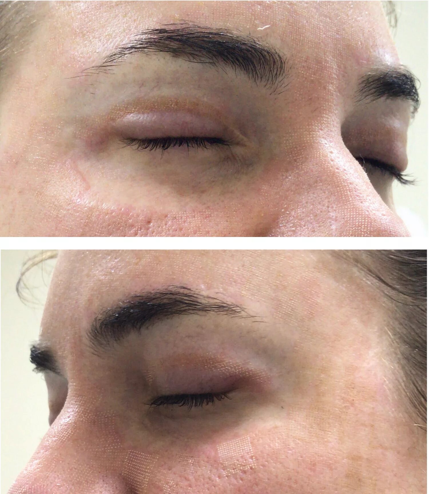 Камуфляж темных кругов под глазами татуаж. Брови сразу после лазера. Отек после лазерного удаления. Отек после удаления татуажа бровей лазером. Отек после лазерного удаления.