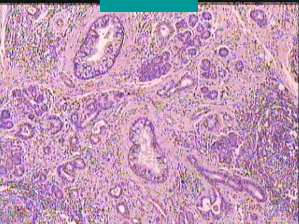 Очаговый гнойно. Сиаладенит гистология. Сиалоаденит патологическая анатомия. Хронический сиалоаденит гистология. Хронические сиалоаденит патологическая анатомия.