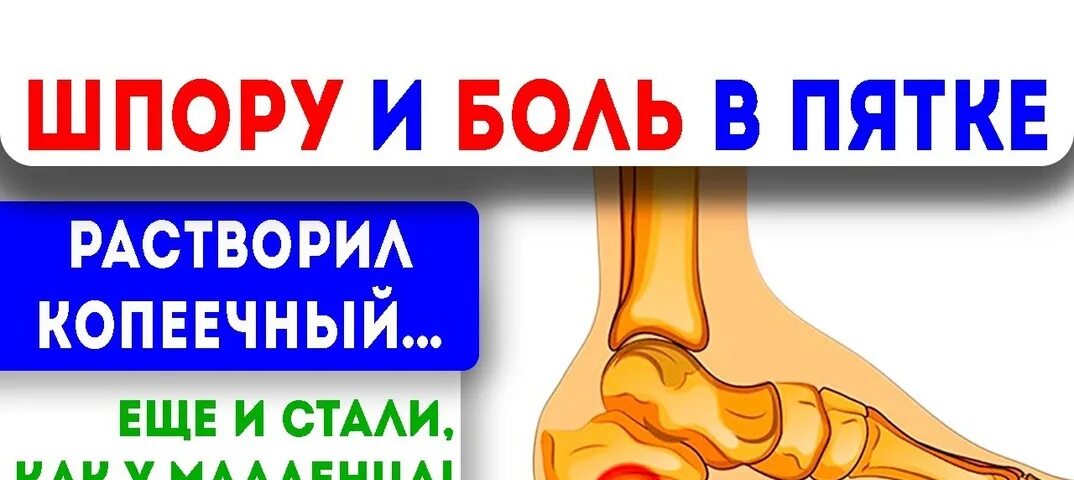Как вылечить шпору форум. Как вылечить шпору форум
