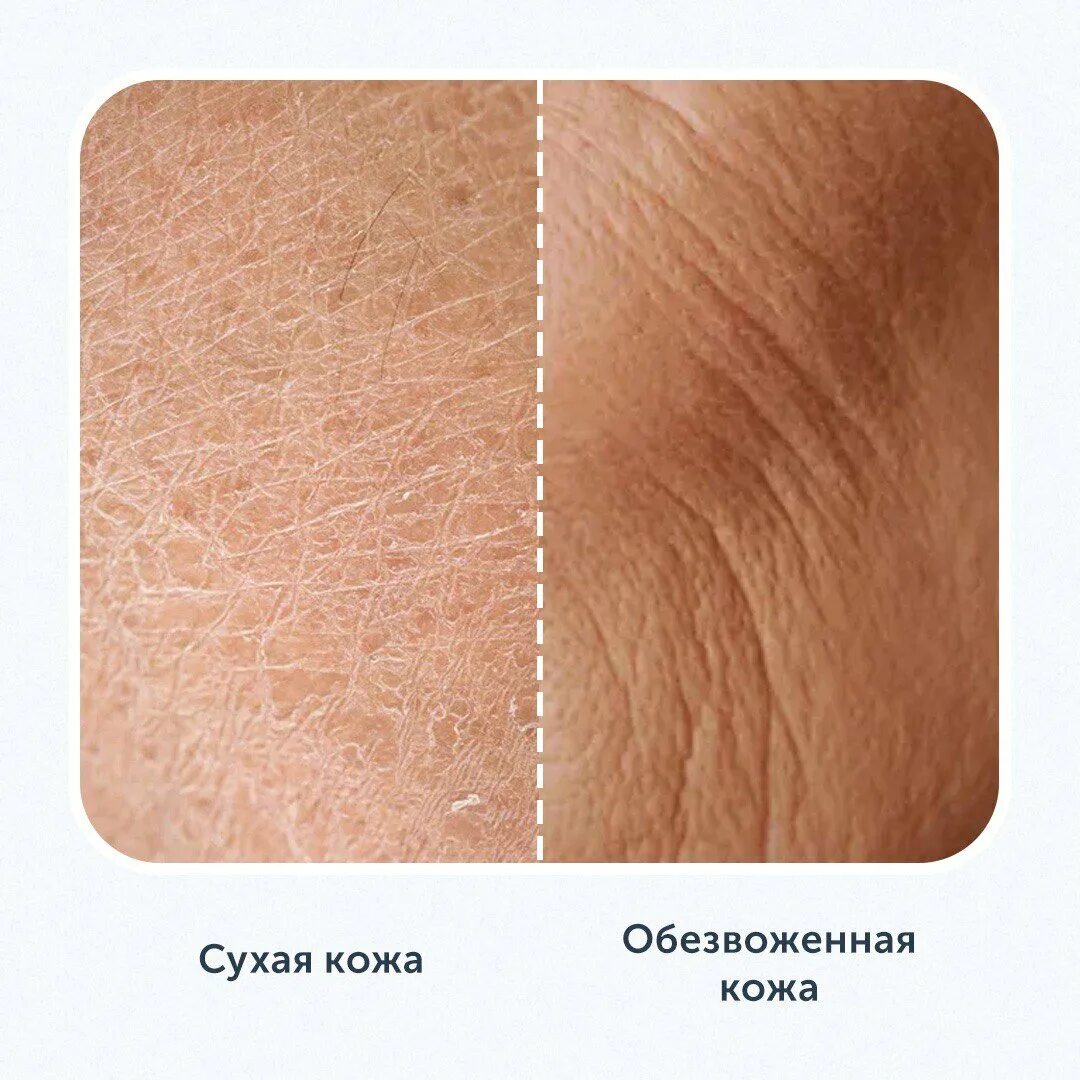 Обезвоженная кожа как выглядит Маска для лица Freeman "Ананас с энзимами" "Отлично подходит для жирной воспал
