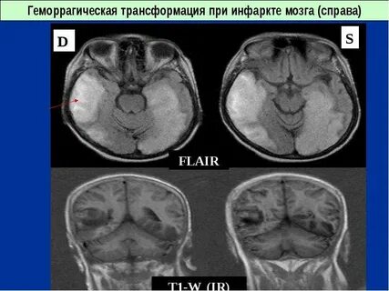 Геморрагическая трансформация ишемического инсульта