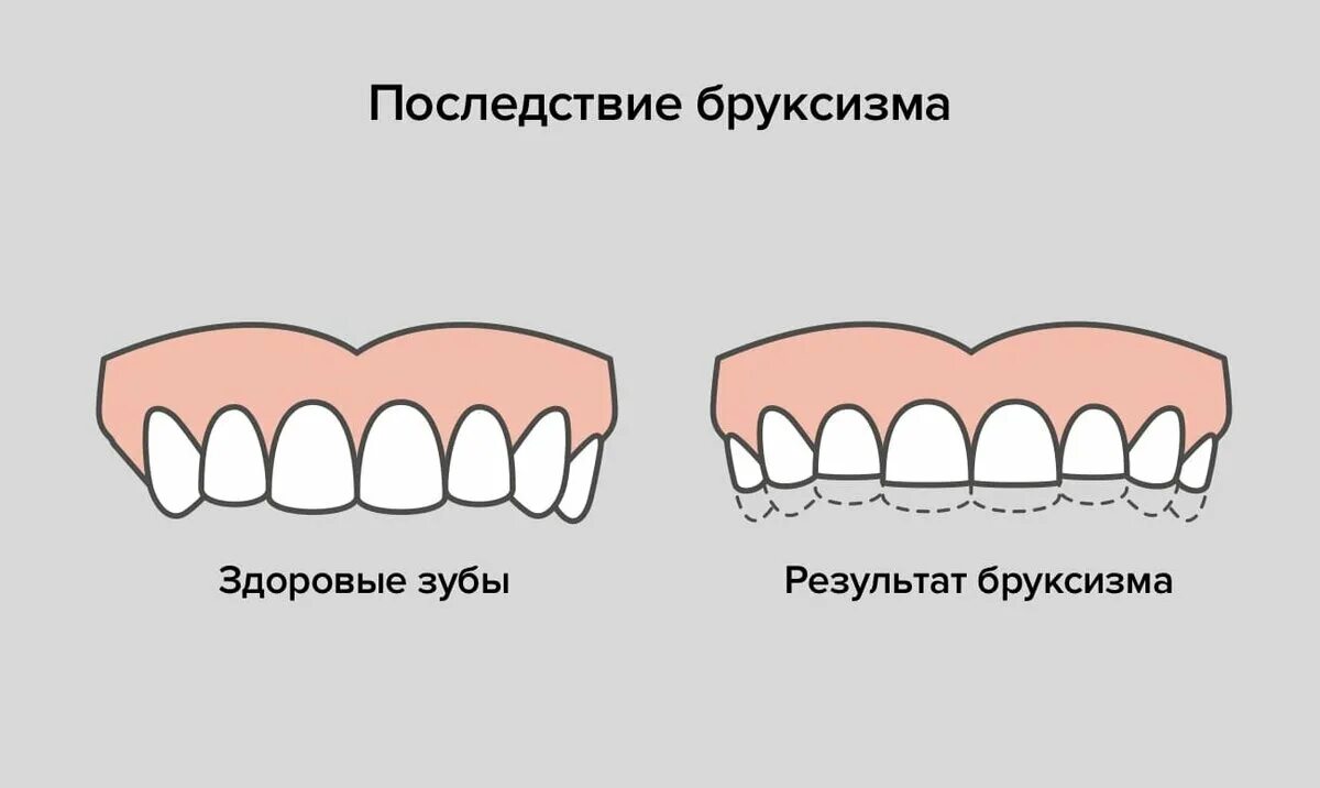 Скрежет зубами у взрослого причины. Бруксизм скрежетание зубами.