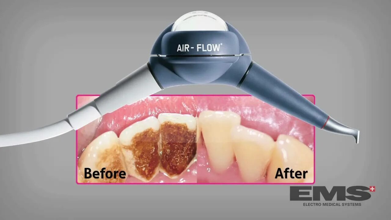 Чистить зубы аппаратом. Наконечник ems Air-Flow для Air-Flow. Профгигиена (ультразвук + Air-Flow). Профгигиена полости рта Air Flow 2022.