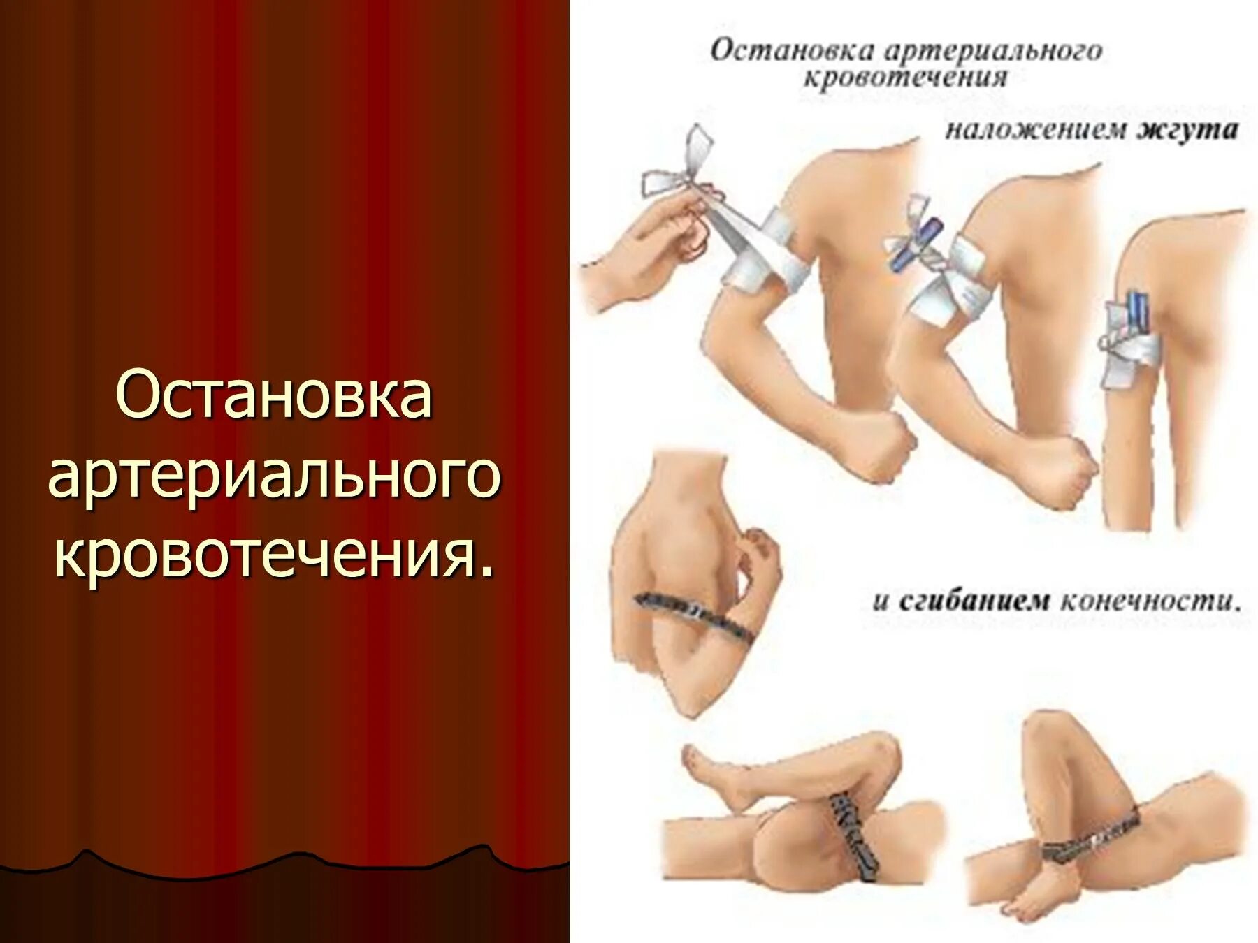 Пути остановки кровотечений. Остановка артериального кровотечения. Метод остановки артериального кровотечения. Остановка кровотечения при артериальном кровотечении. Остановка кровотечени.