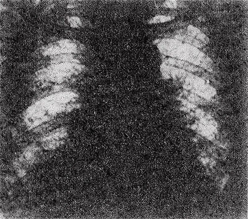 Диагноз фиброзирующий альвеолит. Синдром ричи. Синдром ричи. Болезнь хаммена рича патанатомия. Фиброзирующий альвеолит формулировка диагноза.