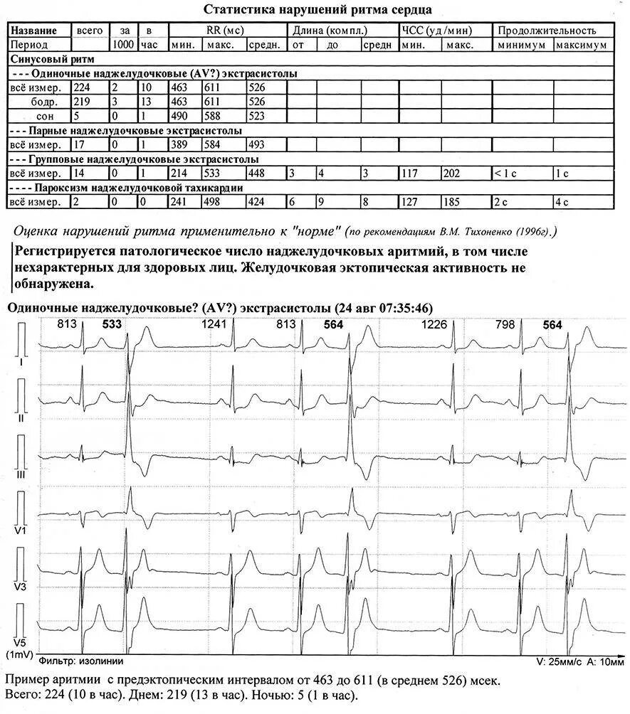 Кардиограмма сердца синусовый ритм норма. Синусовый ритм на ЭКГ норма. Норма ЭКГ синусный ритм. ЭКГ норма ЧСС 75. Норма экстрасистол в сутки по холтеру
