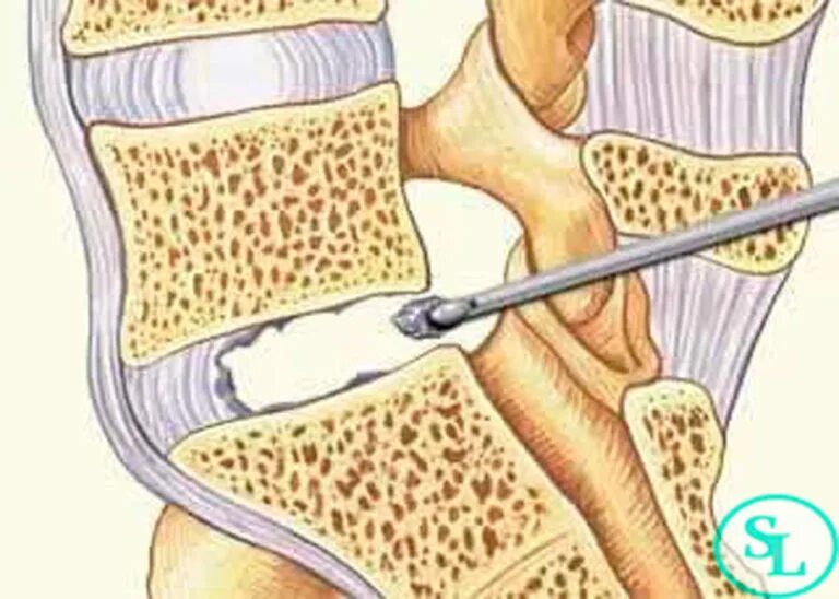 Микродискэктомия грыжи позвоночника. Микродискэктомия поясничного отдела позвоночника l5-s1. Операция грыжа позвоночника микродискэктомия. Эндоскопическая дискэктомия грыжи позвоночника.