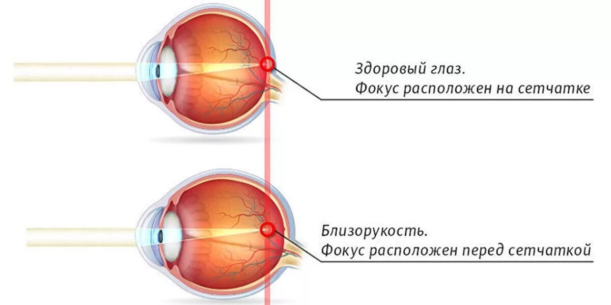 1 это нормальное зрение. Близорукость (истинная и ложная формы патологии). Миопия фокус перед сетчаткой. Близорукость глазное яблоко удлиняется. Удлиненное глазное яблоко при близорукости.