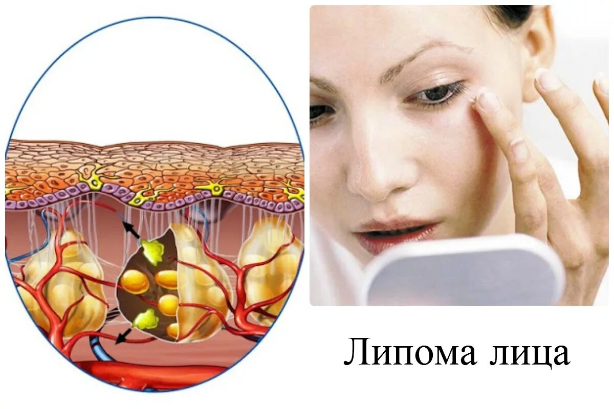 Жировые образования под кожей на лице. Жировик средства лечения