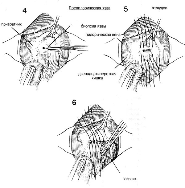 Гастротомия техника операции. Биопсия язвы