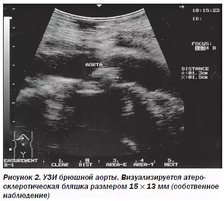 Атеросклероз на узи. Узи брюшного отдела аорты. узи брюшного отдела аорты протокол. протокола исследования брюшного отдела аорты. узи брюшной аорты заключение.