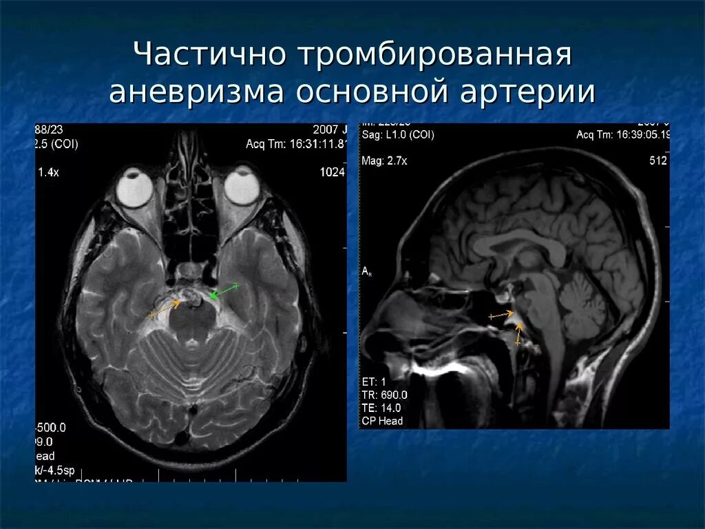 Форум аневризма мозга. Аневризма мозговых артерий кт. Аневризма основной артерии головного мозга кт. Тромбированная аневризма головного мозга.