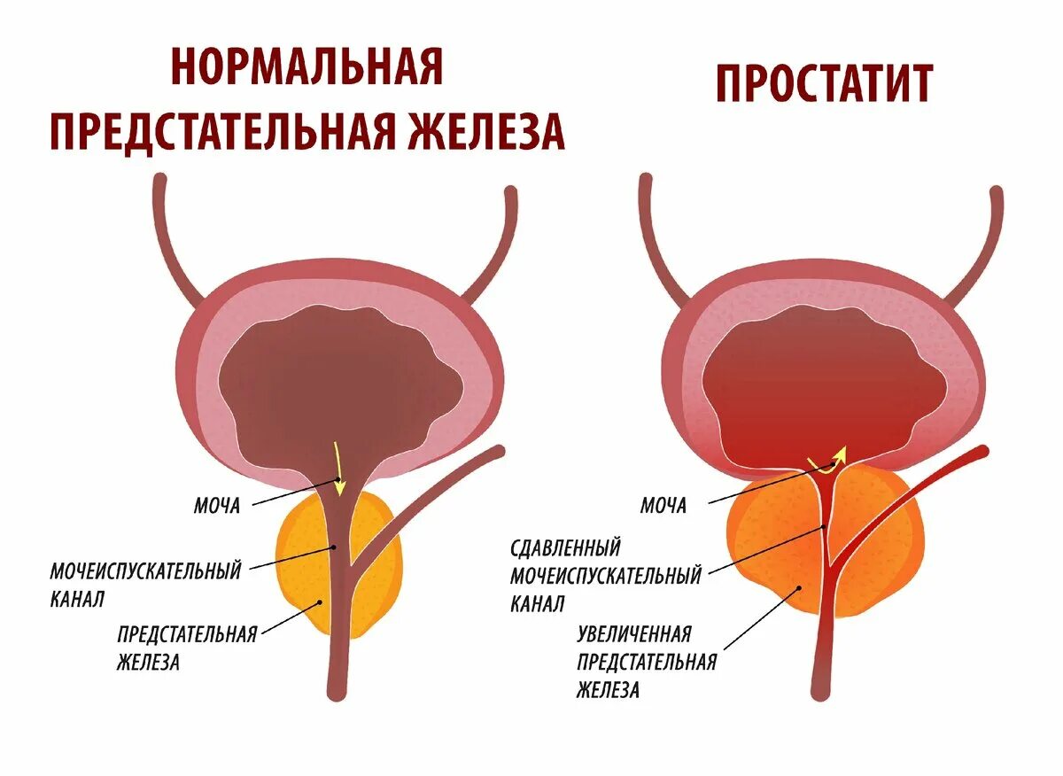 Увеличенная предстательная железа. Простата и предстательная железа. Предстательная железа у мужчин.