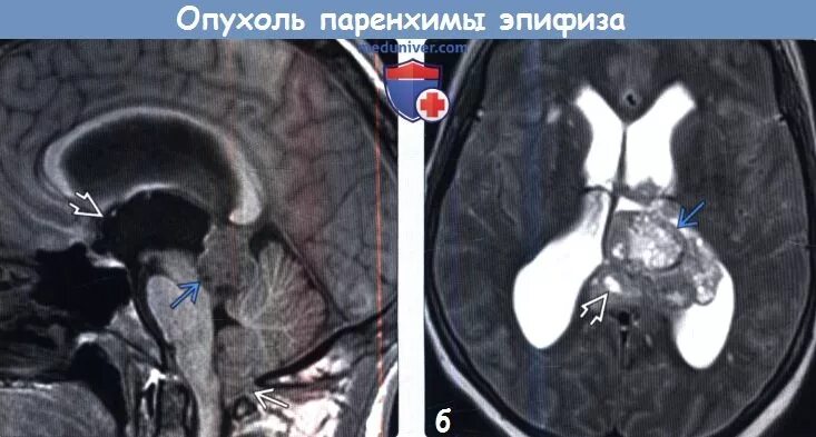 Киста шишковидной железы кт. Микрокиста шишковидной железы. Пинеальная киста в головном мозге. Кистозная трансформация шишковидной железы мрт. Киста шишковидной железы мрт.