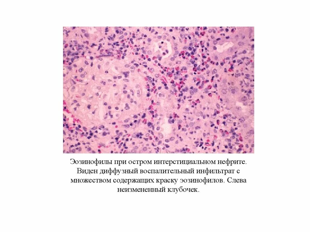 Хронический интерстициальный нефрит микропрепарат. Межуточный нефрит микропрепарат. Межуточный Гнойный нефрит микропрепарат. Межуточный Гнойный нефрит рисунок. Пиелонефрит микропрепарат
