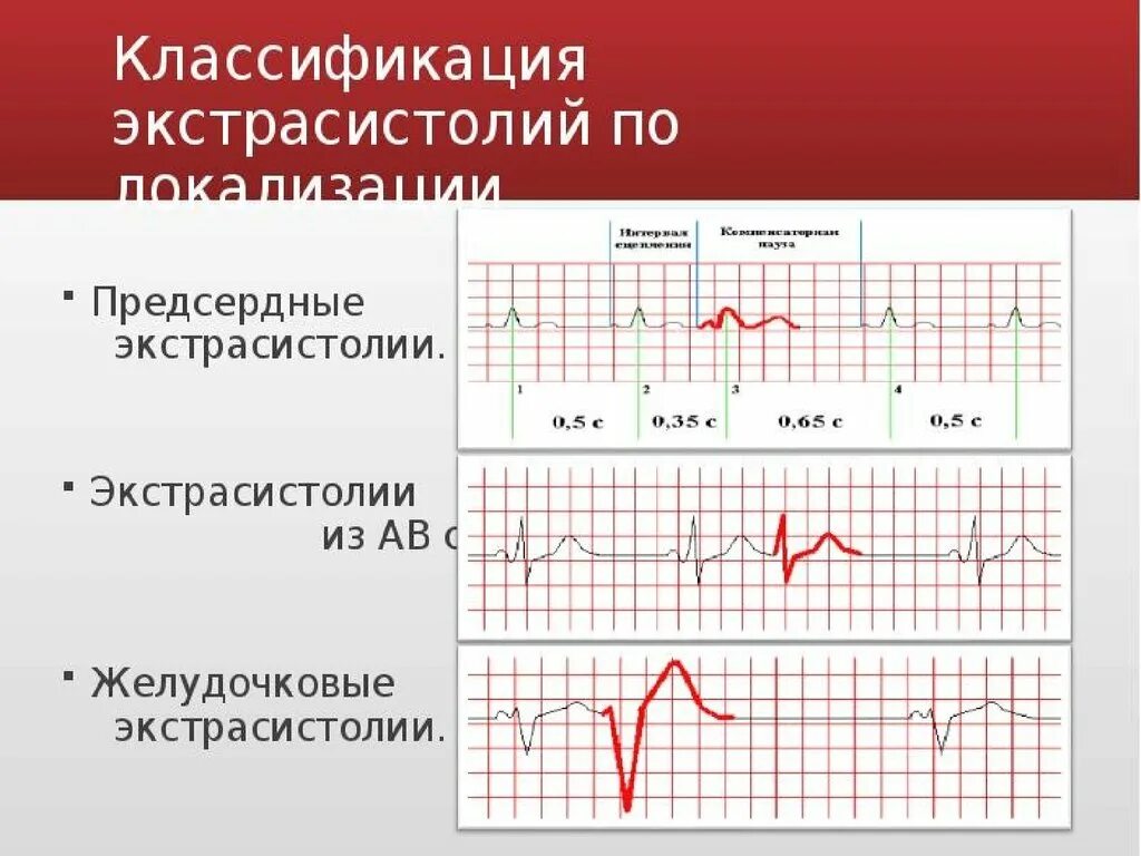 Суправентрикулярная экстрасистолия на ЭКГ. Желудочковые экстрасистолы классификация ЭКГ. Наджелудочковая предсердная экстрасистолия ЭКГ. Желудочковая экстрасистолия на ЭКГ. Типы желудочковых экстрасистол