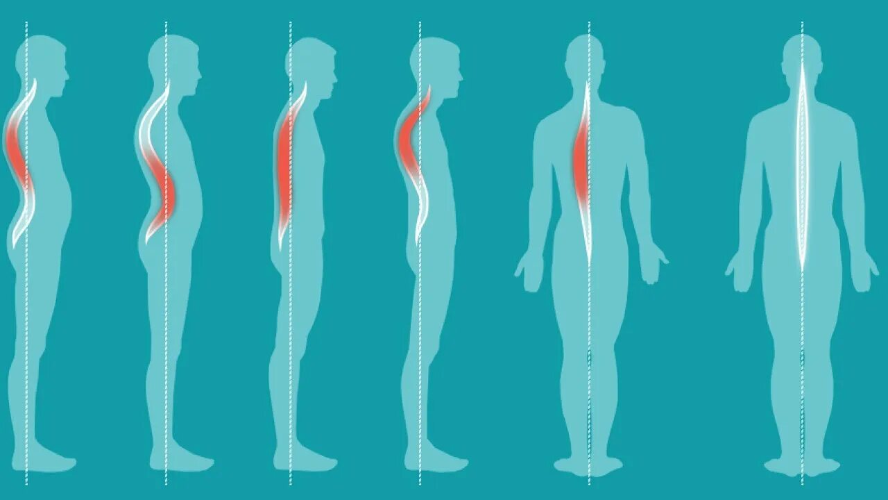 Лордоз кифоз сколиоз сутулость. Типы осанки человека лордоз. Типы нарушения осанки лордоз. Сколиоз лордоз кифоз плоская спина. Правильная поясница