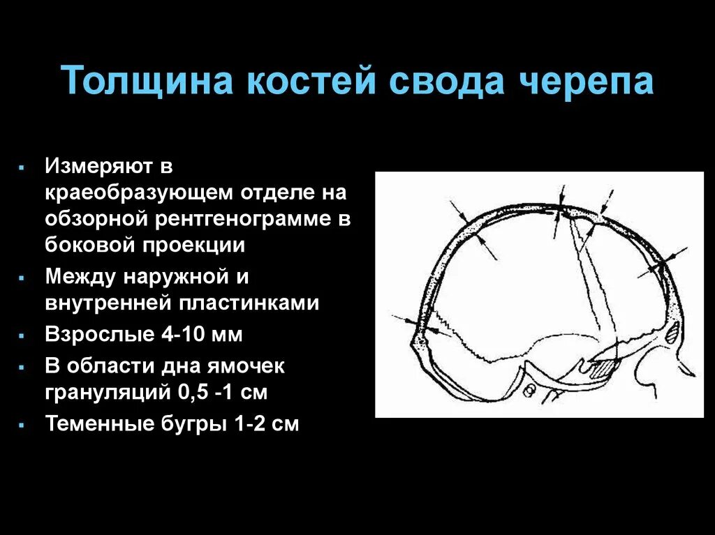 Кости черепа рентген норма. Толщина костей черепа человека в норме. Рентгеноанатомия костей черепа. Свод черепа кости его образующие. Слои свода