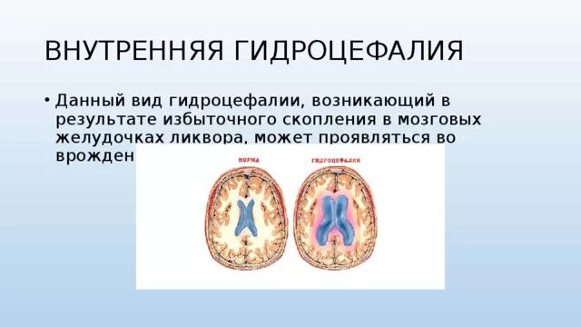 Внутренняя гидроцефалия. Симметричная внутренняя гидроцефалия. Незначительная внутренняя гидроцефалия. Неокклюзионная гидроцефалия.