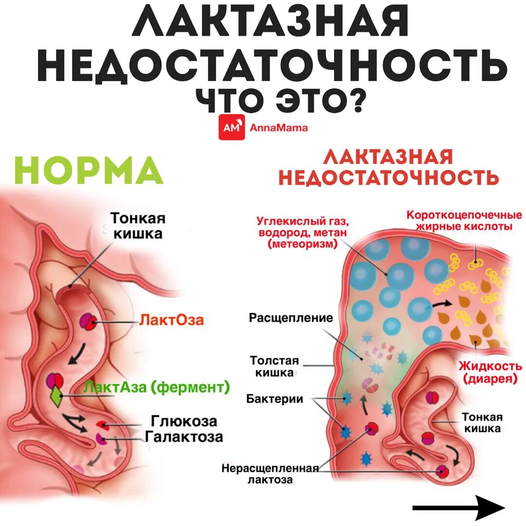 Проблема кишечника кровь. Лактощеая недостаточность симптомы. Лактазная недостаточность симптомы. Непереносимость лактозы. Лактазная недостаточность у детей.