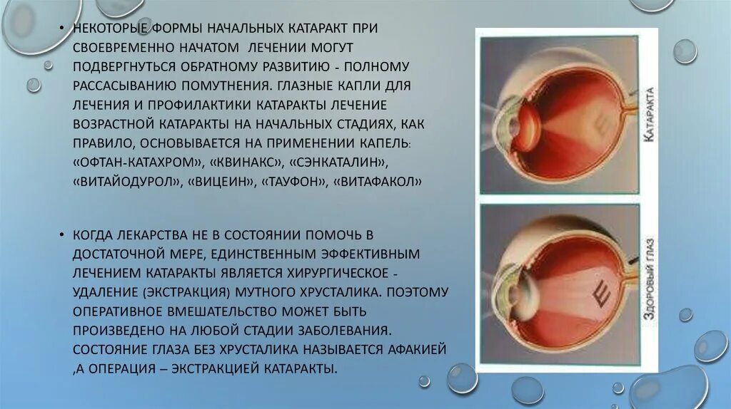 Этапы экстракции катаракты. Пациента к экстракции катаракты. Что делать после операции по замене хрусталика