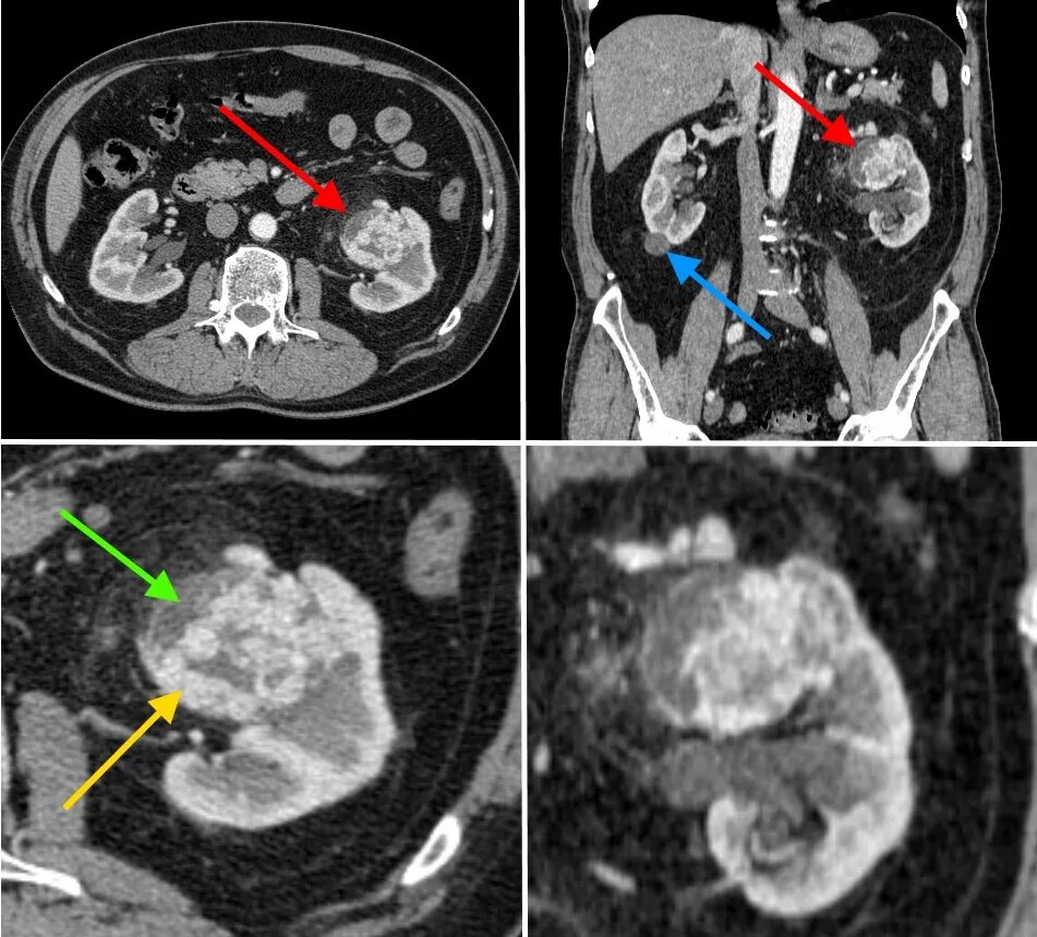 Кт с контрастированием опухоль почки. На кт видно опухоль
