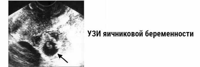 Можно ли на узи увидеть внематочную беременность. Внематочная беременность симптомы узи. внематочная трубная беременность узи. разрыв трубы при внематочной беременности узи. внематочная яичниковая беременность на узи.