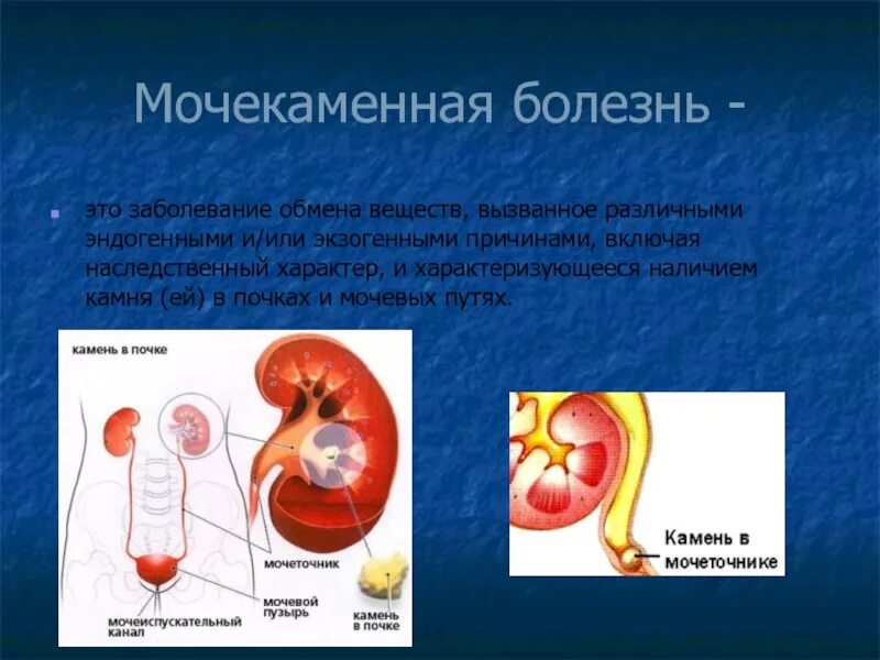 Мочекаменная болезнь врач