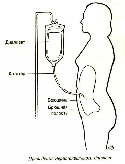 Перитониальный диализ. Перитонеальный катетер для диализа. Диализный катетер в брюшной полости. Лапароцентез брюшной полости при асците. Схема перитонеального диализа.