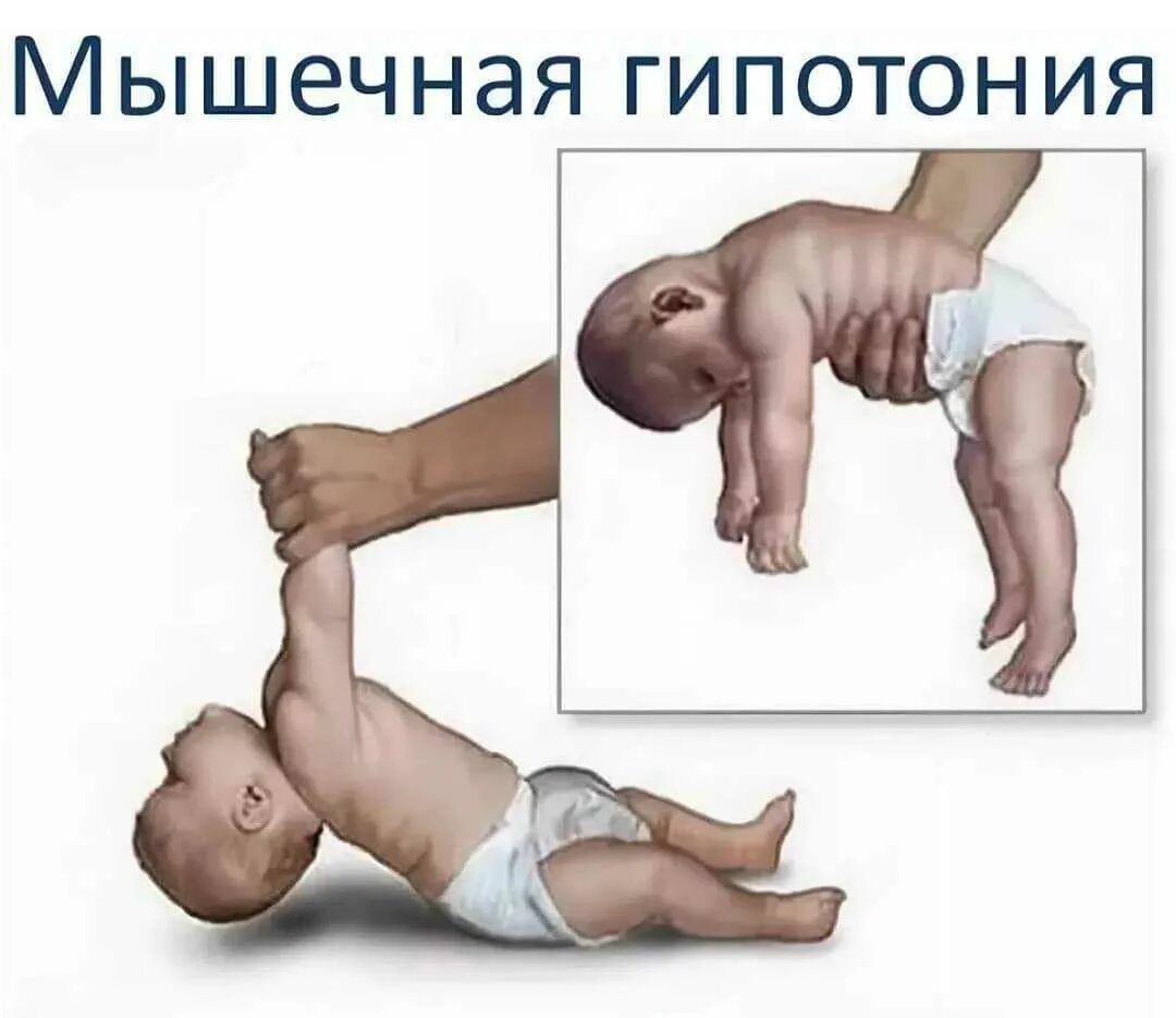 Почему при нарушении мышечного чувства человек. Гипертонус и гипотонус мышц у ребенка. нарушение мышечного тонуса при дцп. мышечный тонус.