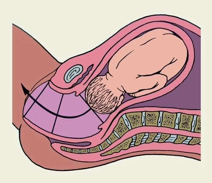 Раскрытие шейки матки при беременности. Первый период родов раскрытие шейки матки. Раскрытие шейки матки при родах периоды. Раскрытие шейки матки в родах.
