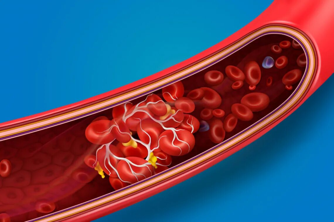 Возникновение тромбов