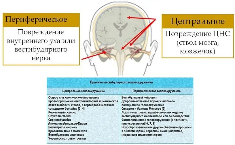 Головокружение после 50 лет причины. Периферическое вестибулярное головокружение. заболевания вестибулярного аппарата. центральный вестибулярный синдром. терапия вестибулярных головокружений.