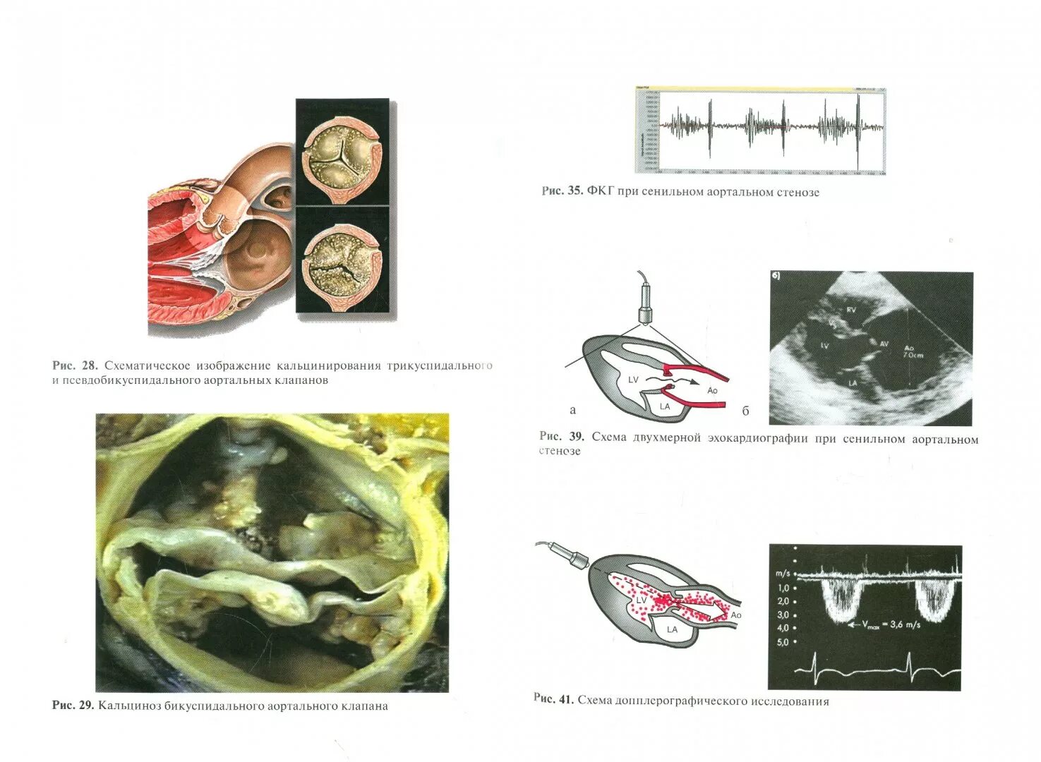Кальцинат створки аортального клапана. Кальцификация створок аортального клапана. Кальциноз створок клапанов сердца. Кальциноз аортальный клапан сердца.