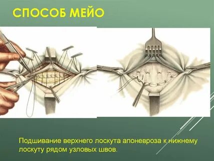 Пупочная грыжа методы операции
