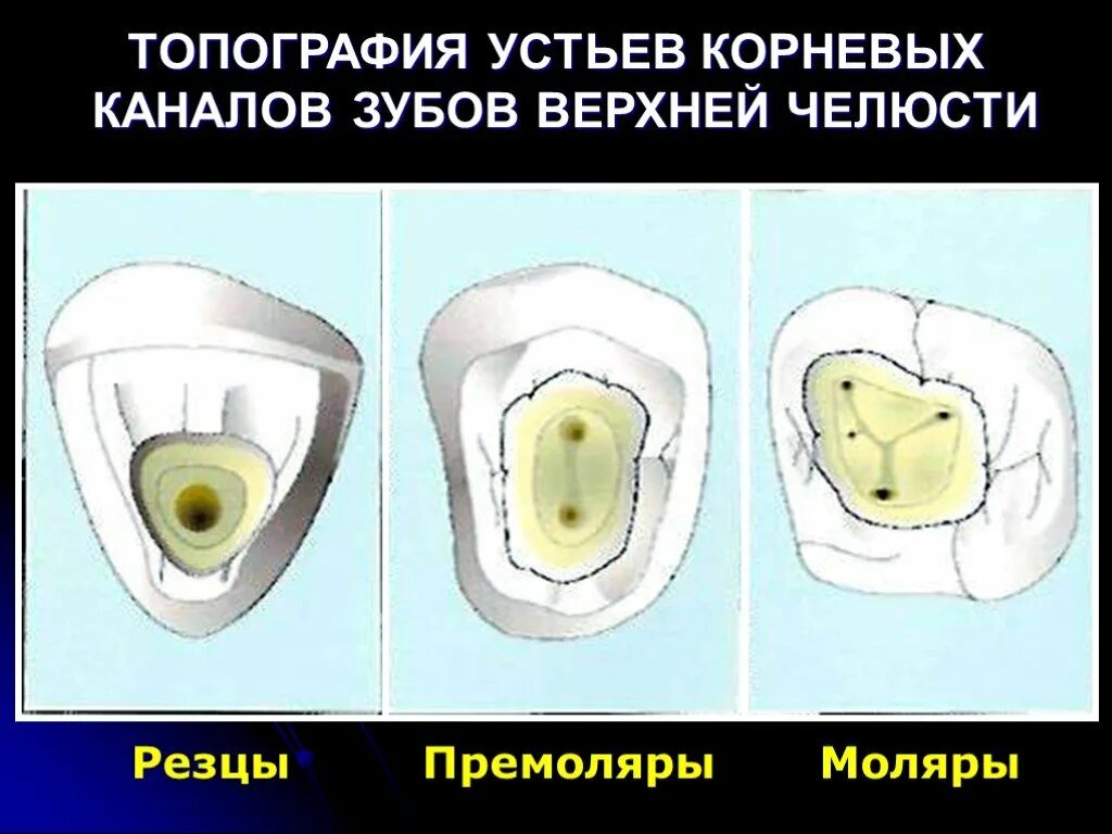 Топография устьев корневых каналов 26 зуба. Топография устьев корневых каналов зубов нижней челюсти. Топография корневых каналов 16 зуба. Расположение устьев корневых каналов в 26. Каналы верхней 6