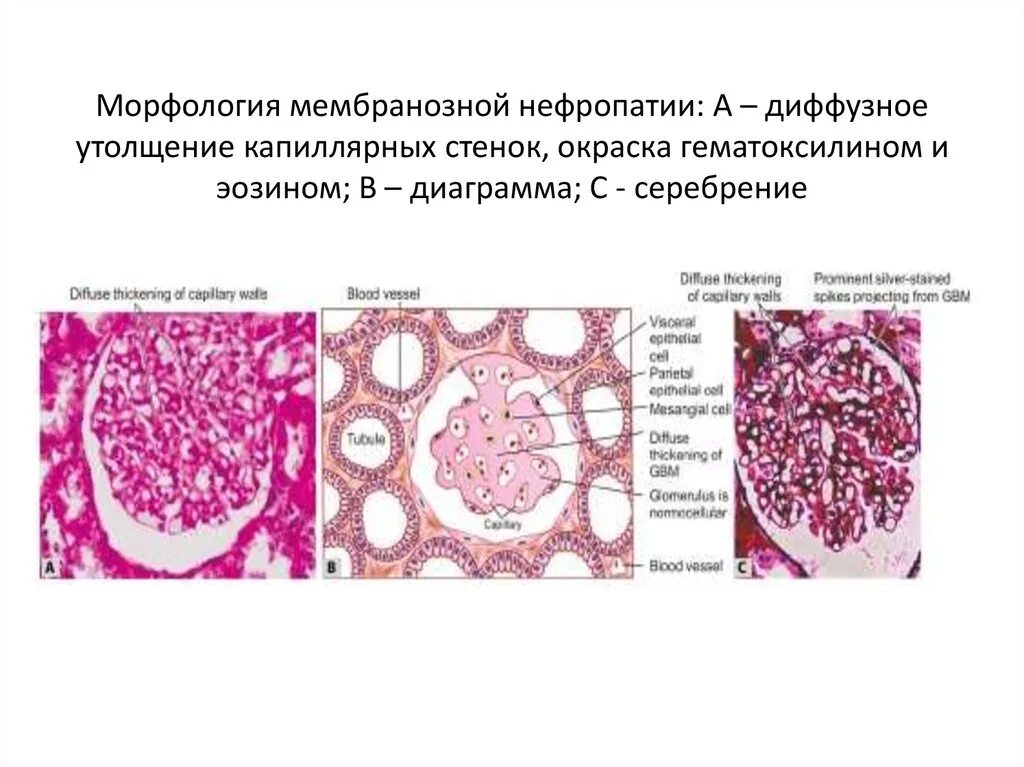 Диффузное утолщение стенок