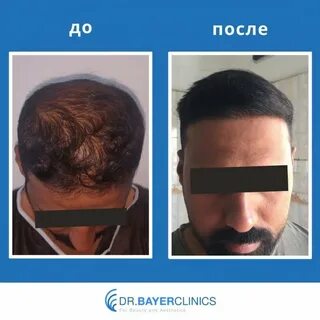 Через сколько после пересадки