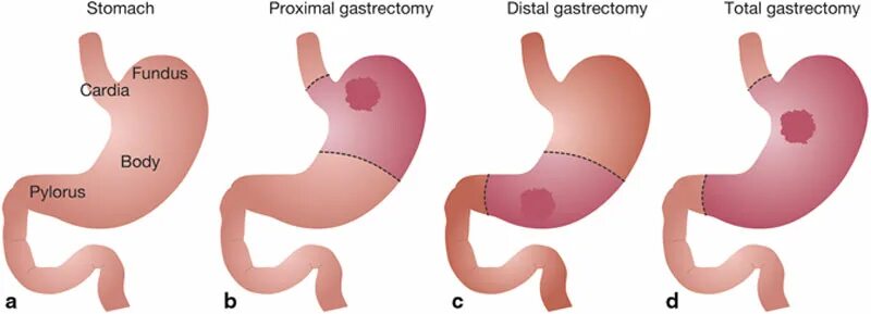 Схема субтотальной резекции желудка. Проксимальная резекция желудка схема операции. Дистальная резекция желудка операция. Дистальная субтотальная резекция желудка. Операция удаления опухоли желудка