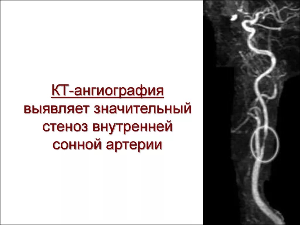 Стеноз устья вса. Мрт ангиография аневризма внутренней сонной артерии. Кт ангиография аневризма. Стеноз внутренней сонной артерии кт. Кт ангиография сонных артерий.