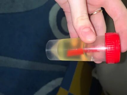 Есть ли песок в моче - Вопрос нефрологу - 03 Онлайн